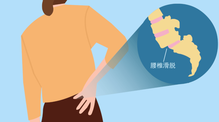 腰椎 滑 脫 腰椎 滑 脫