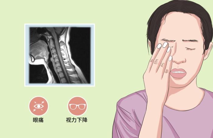 視神經 脊髓 炎