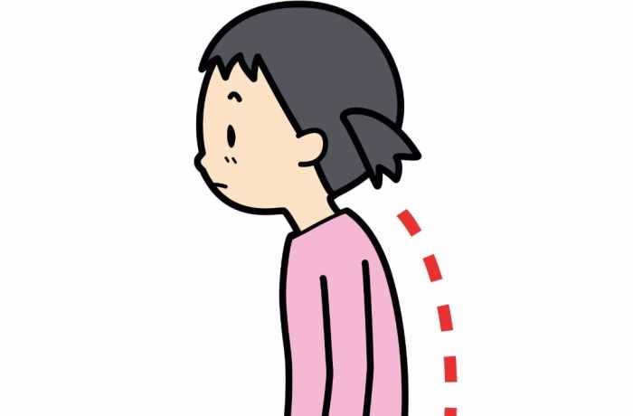 小孩駝背原因 小孩駝背原因
