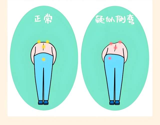 脊椎側彎治療運動 脊椎側彎治療運動