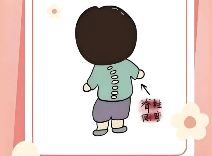 脊椎側彎症狀 脊椎側彎症狀