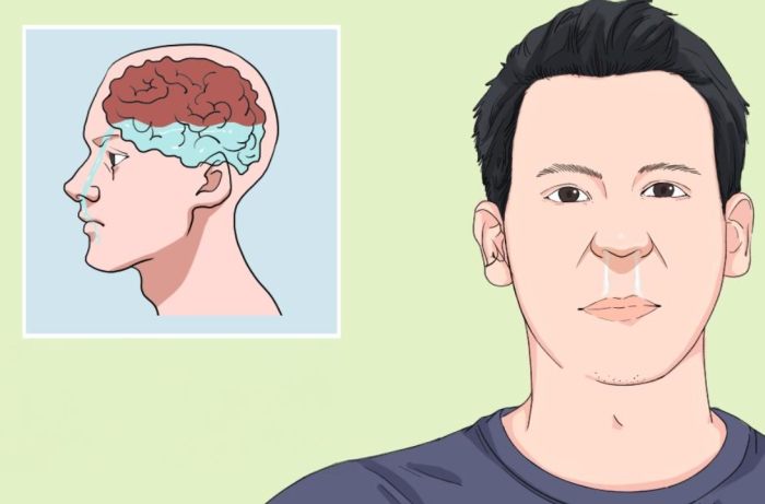 腦 脊髓 液 外 漏