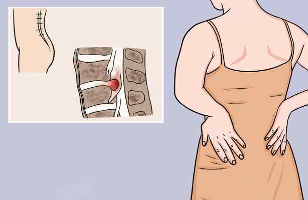 腰椎間盤鈣化 腰椎間盤鈣化