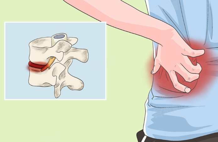 椎間盤鈣化治療 椎間盤鈣化治療