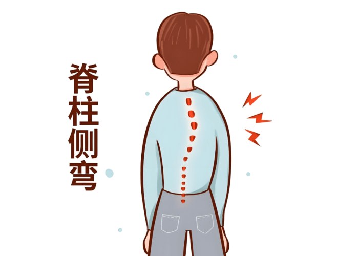 脊椎側彎不能做什麼運動