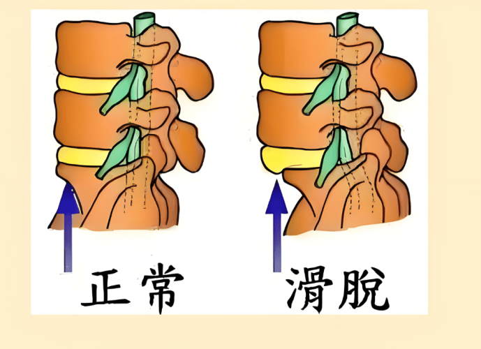 椎間盤滑脫手術