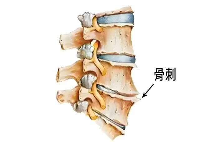 脊椎骨刺如何治療 脊椎骨刺如何治療