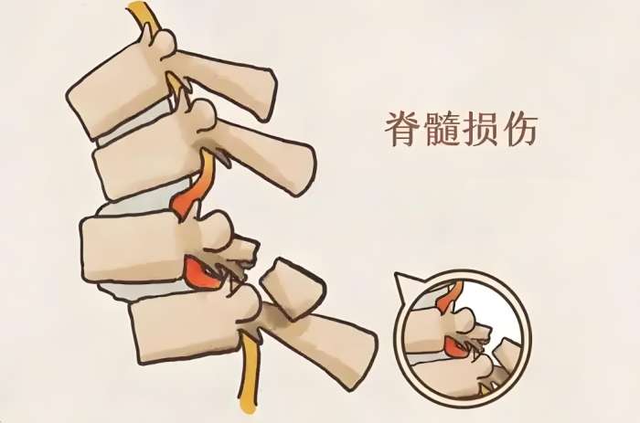 脊髓損傷 脊髓損傷